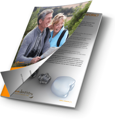 Dental Implants Guide
